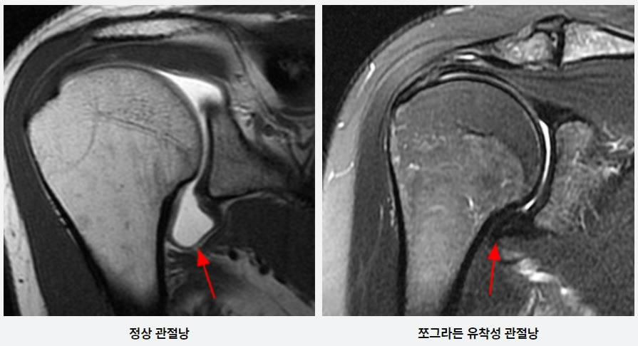 어깨 관절 유착