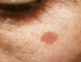 Manchas solares y de la edad en el rostro