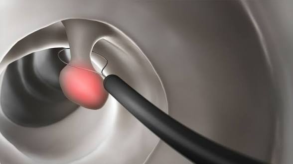 Polyps Treatment