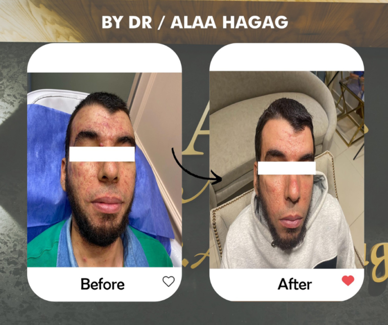  علاج حب شباب في الوجه في مركز د. علاء حجاج

