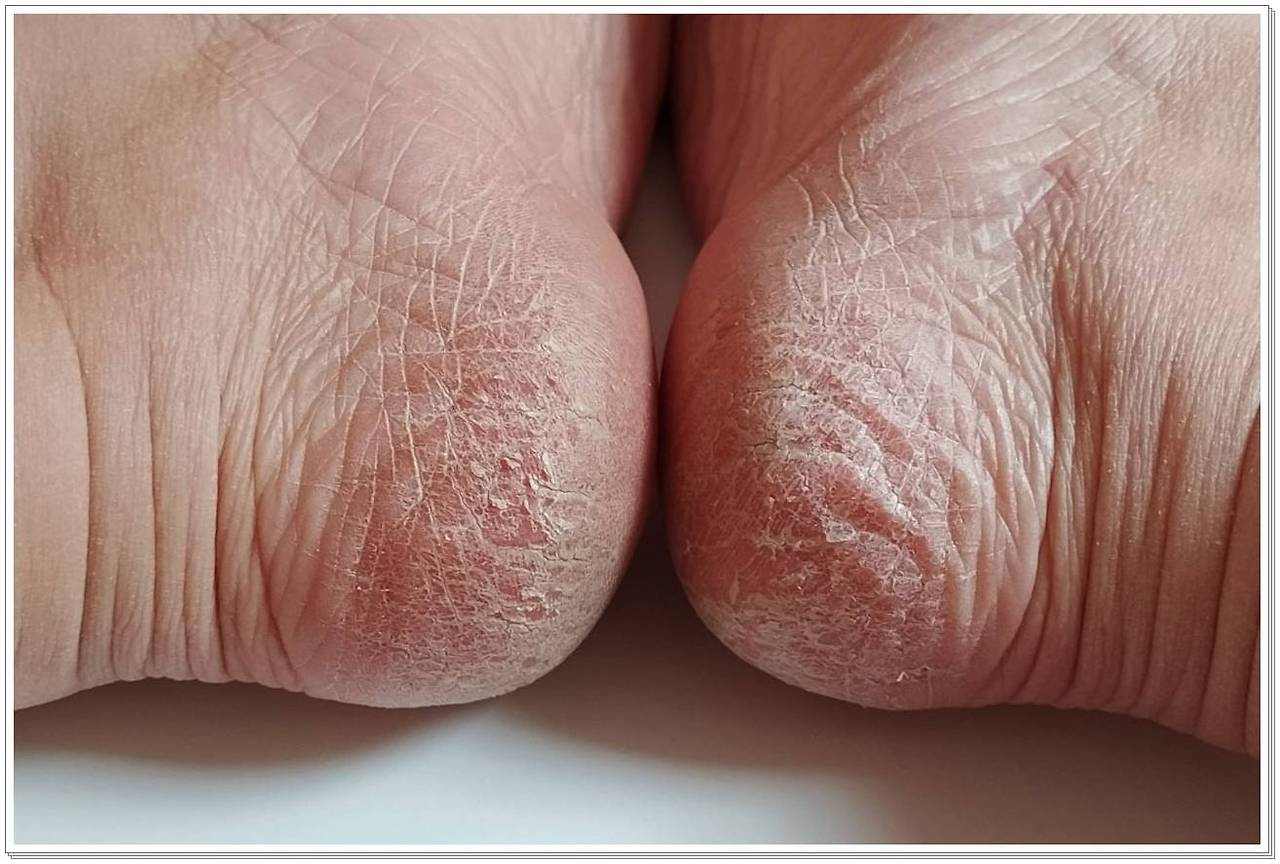 발뒤꿈치 각질, 다시 생기지 않게 하는 꿀팁 공개!