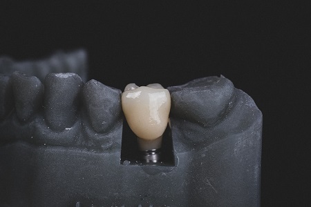 Tooth-Implant-Cost