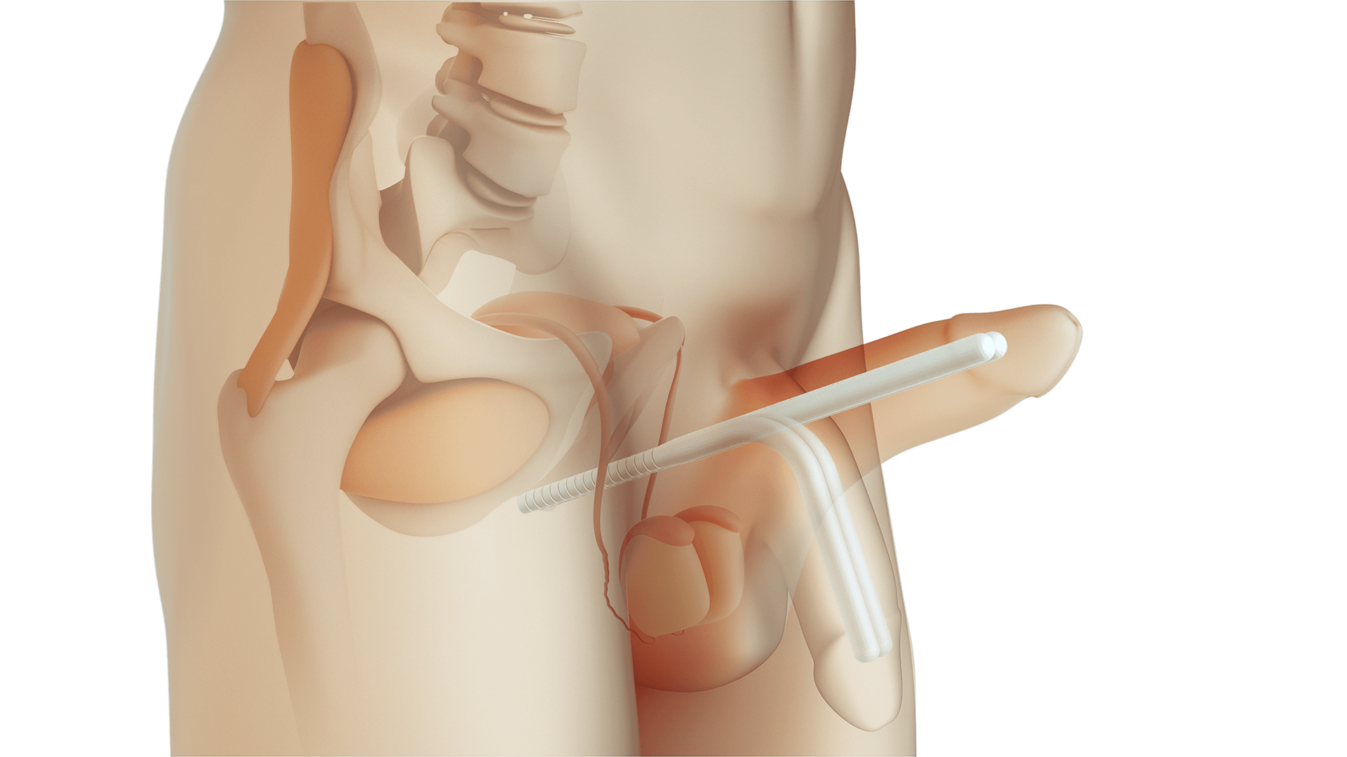 When a Malleable Implant Becomes Part of Daily Routine