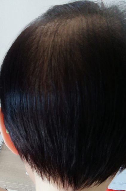 chute de cheveux femme de derrière