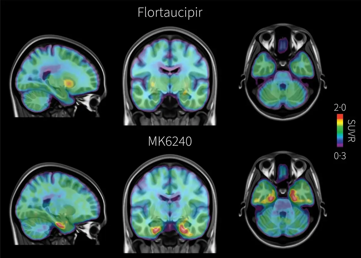 New Brain Imaging Technique Detects Alzheimer's Tau Protein Earlier