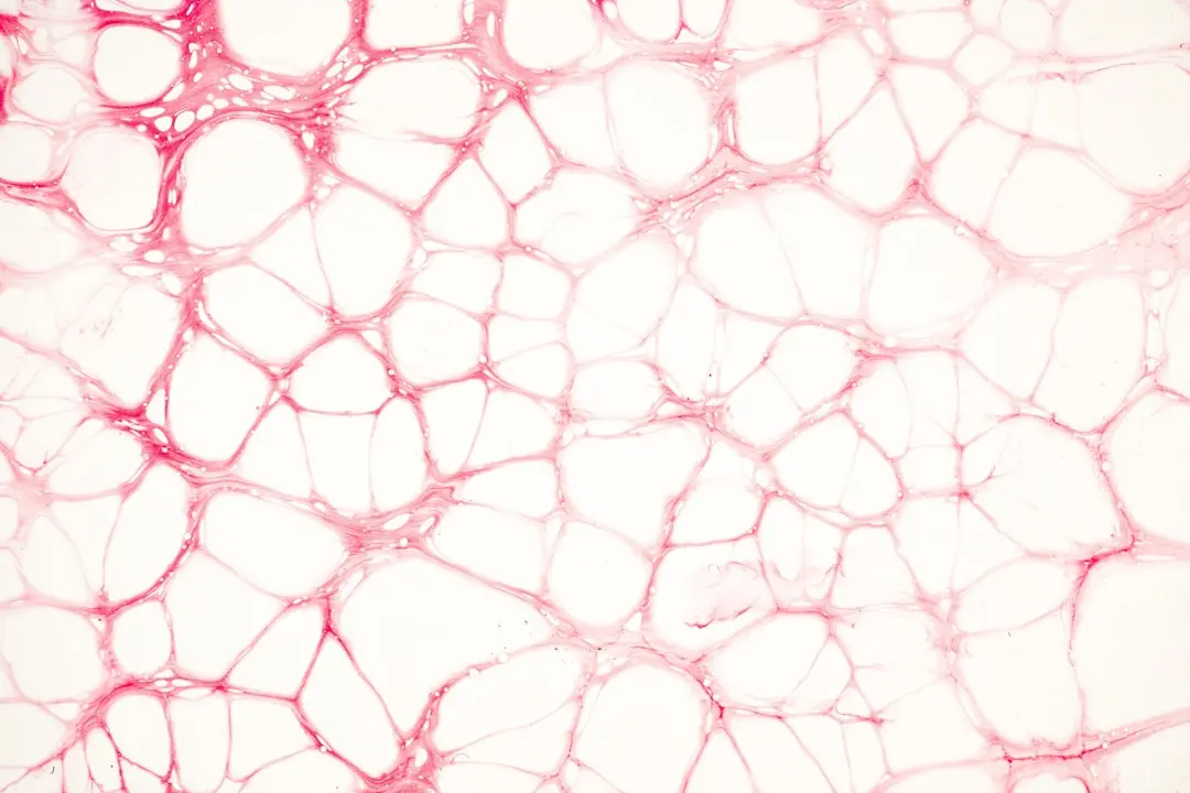 Microvascular Dysfunction Fuels Heart Disease