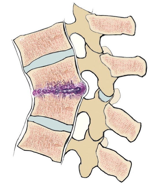 Pyogenic spondylodiscitis
