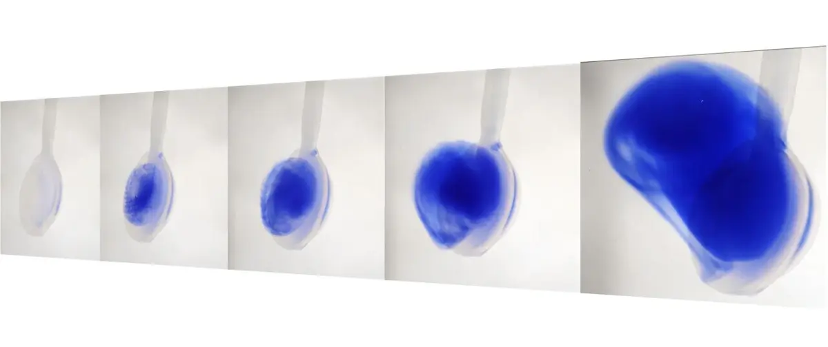 New Implant Offers Hope for Ovarian Cancer Treatment