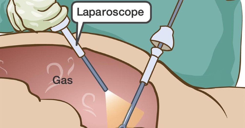 What-is-Minimal-Access-Surgery-or-Keyhole-Surgery