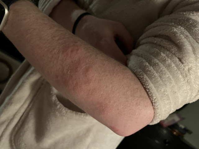 rash3
