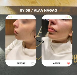 نتيجة حقن فيلر الشفايف قبل وبعد من الجانب عند د. علاء حجاج