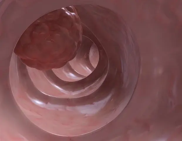 New Research Offers Hope for Combating Drug Resistance in Colorectal Cancer