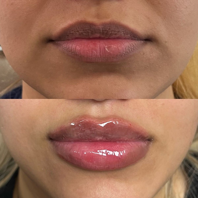 Lipparazzi Instant Filler Lips before and after