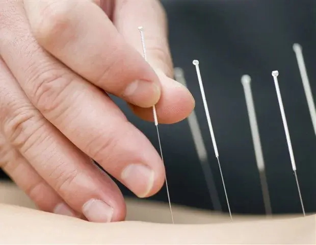 Stroke Patients See Improved Muscle Function with Acupuncture