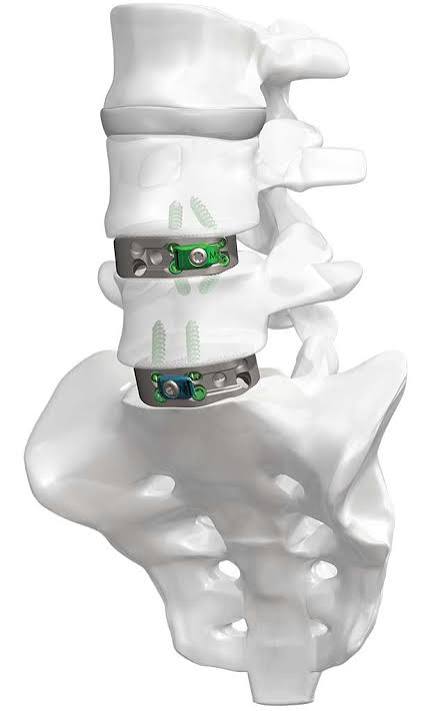 ALIF anterior lumbar interbody fusion