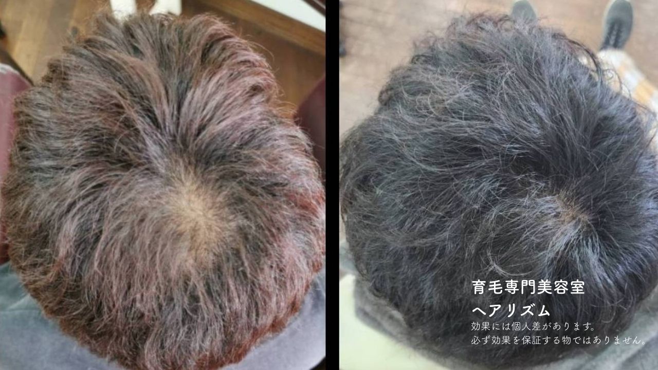 頭皮確認の様子