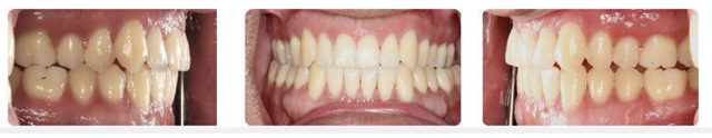 post-ortho-bite