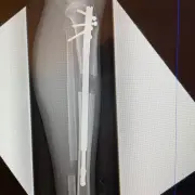 TIBIAS & FEMURS with Dr. Becker & Dr. Betz – FULL JOURNEY (8+5=13 CM)
