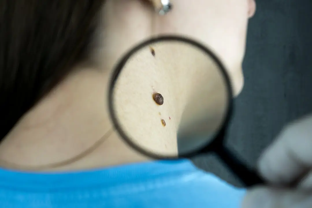 Skin Cancer Self-Diagnosis by a Dermatologist