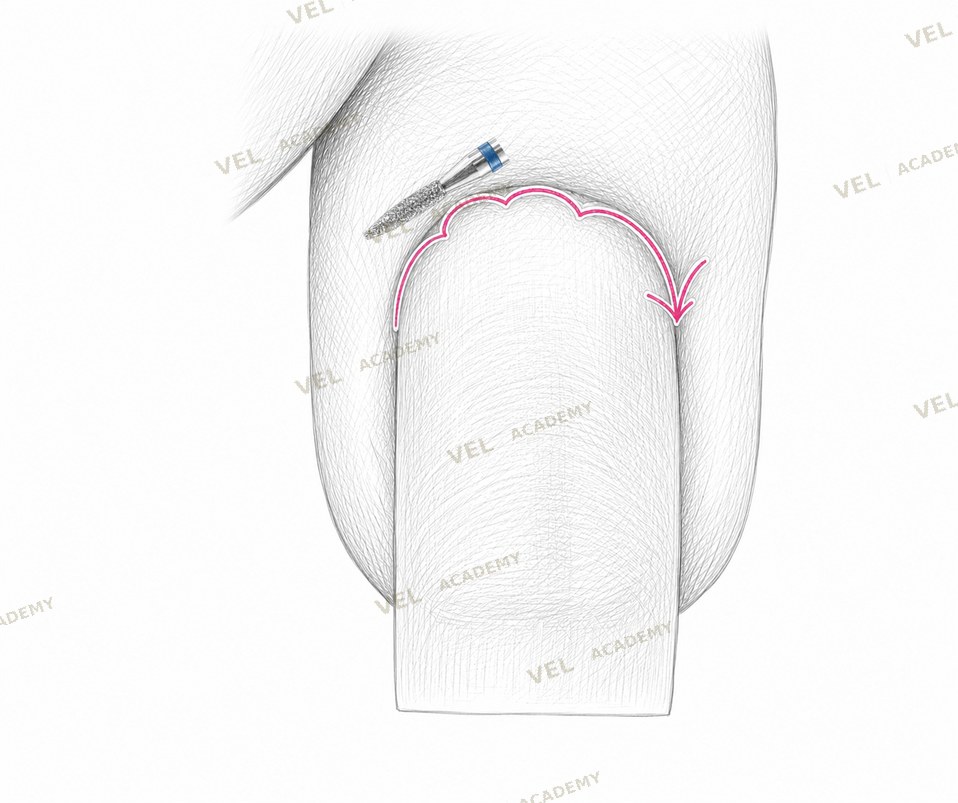 Flame bit REW finishing pass after cuticle scissors left sinus to right