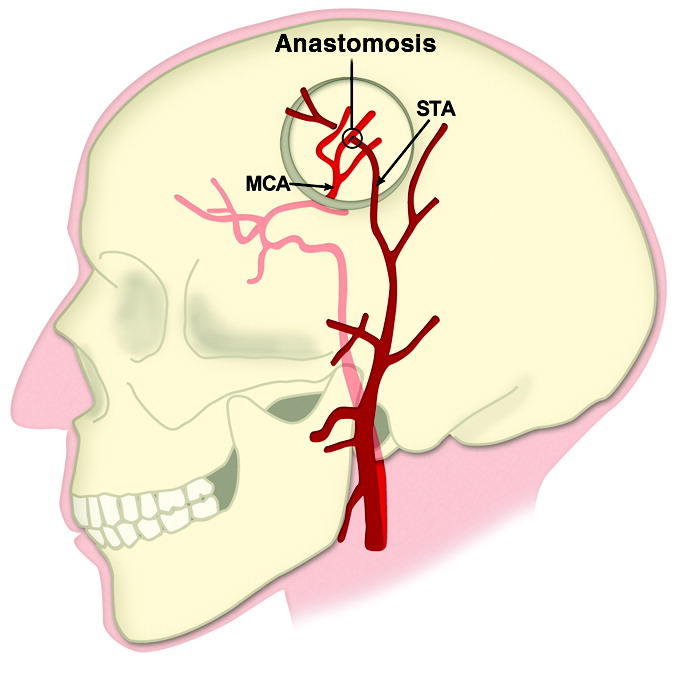 STA-MCA bypass anastomosis cerebral revascularisation