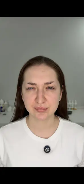 Межбровье после