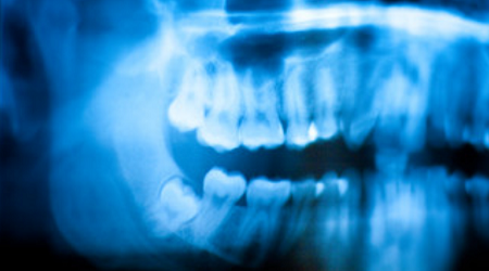 Wisdom-Teeth-Removal-Cost-Sydney