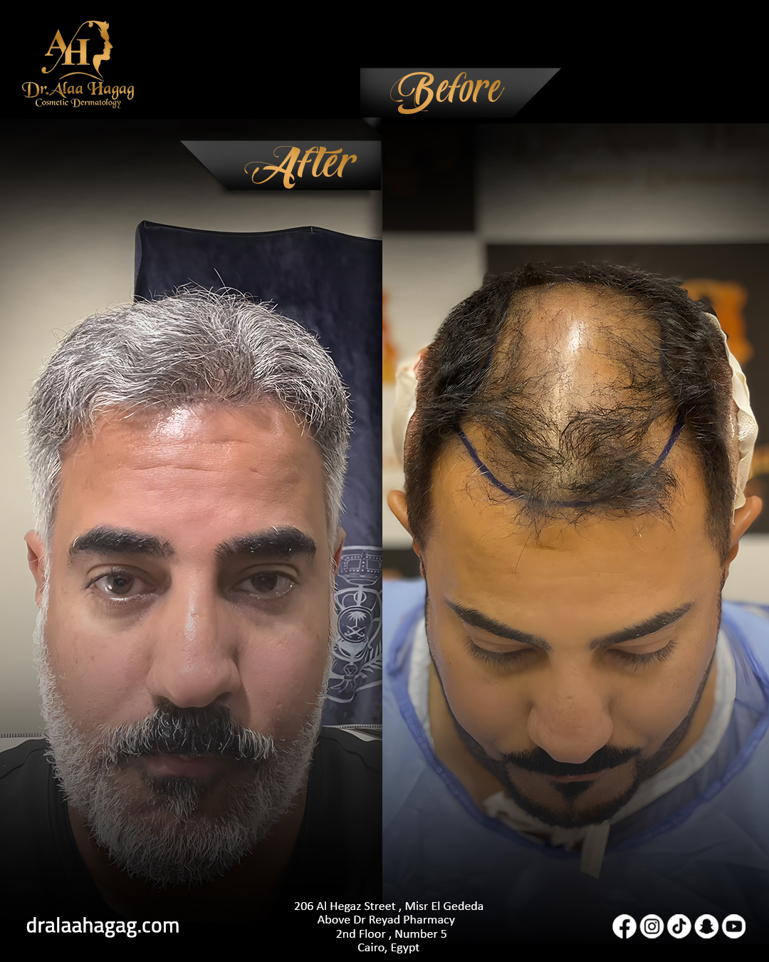 زراعة الشعر للرجال قبل وبعد