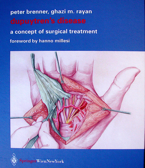 Dupuytren's Disease