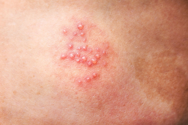 Immune Health Research - Herpafend