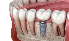 Tooth Implants Sydney Tooth-Implants-Sydney
