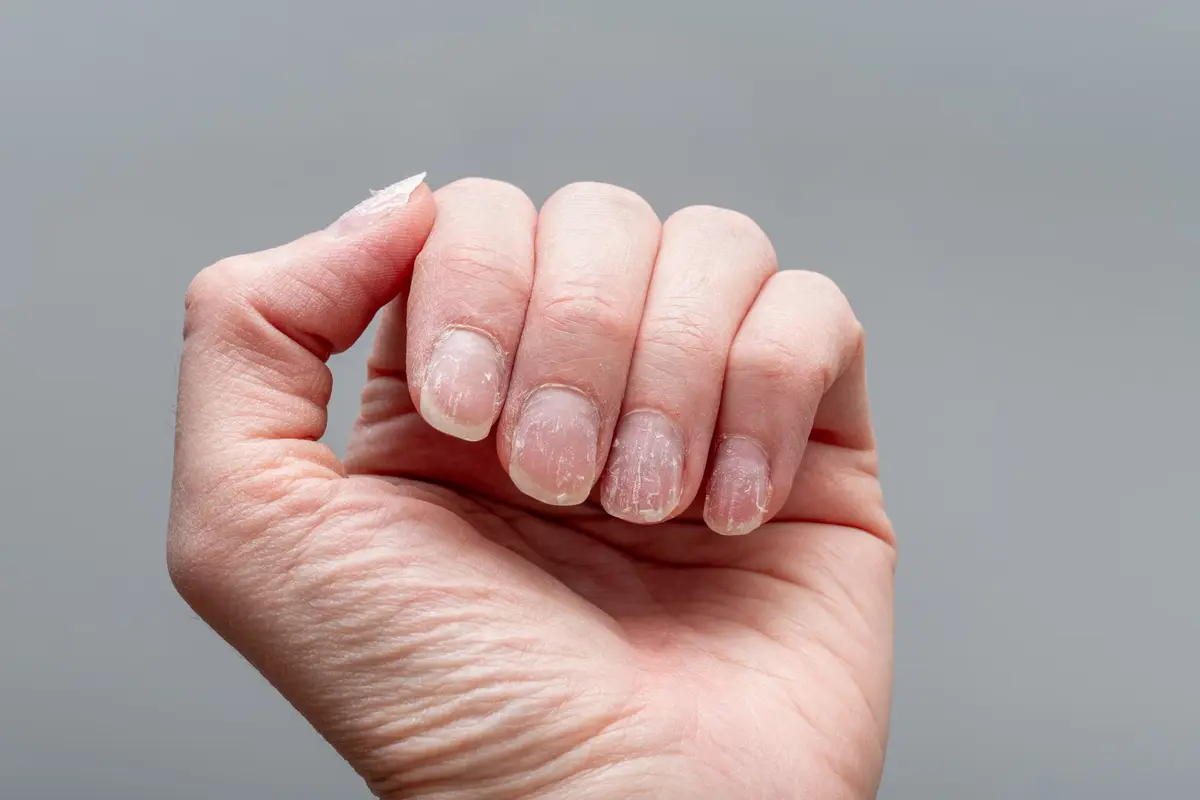 Fixing Peeling Nails: Expert Advice