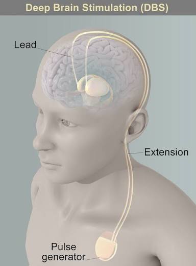 Deep brain stimulation DBS Parkinsons