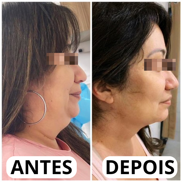 Resultado real antes e depois da papada 6