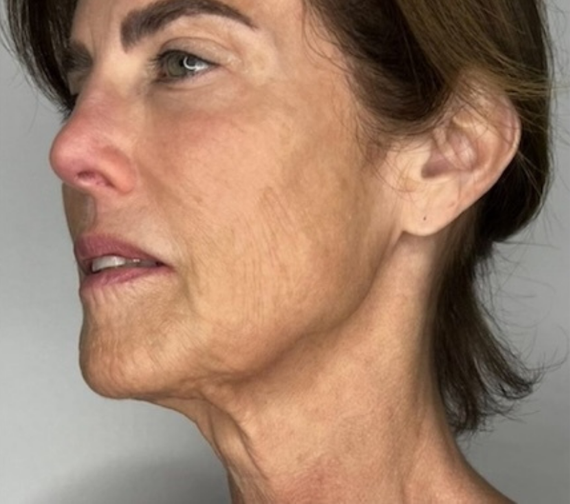 Before Sofwave treatment at Let's Face It Med Spa