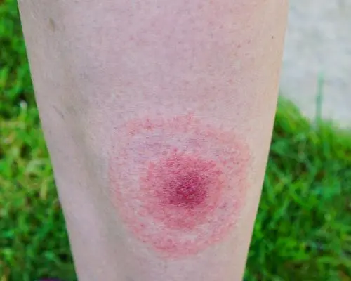 Rise in Lyme Disease Cases Sparks Concern in England
