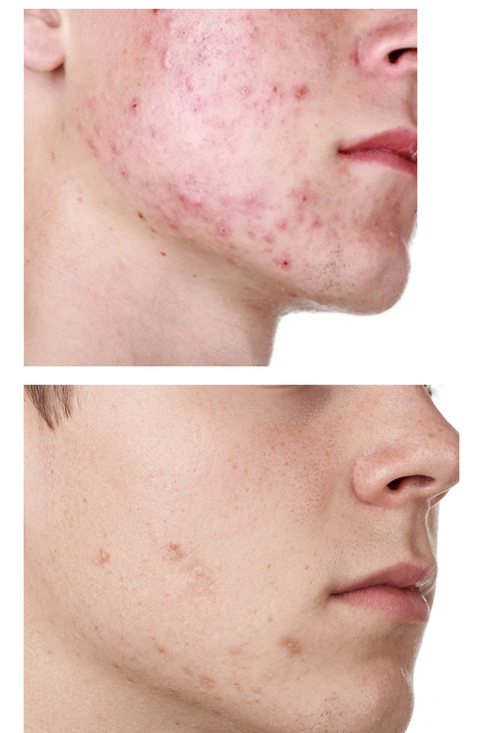 Antes e depois