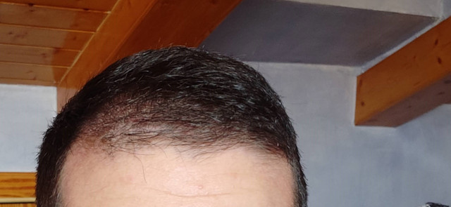 3-MESES-POST-2