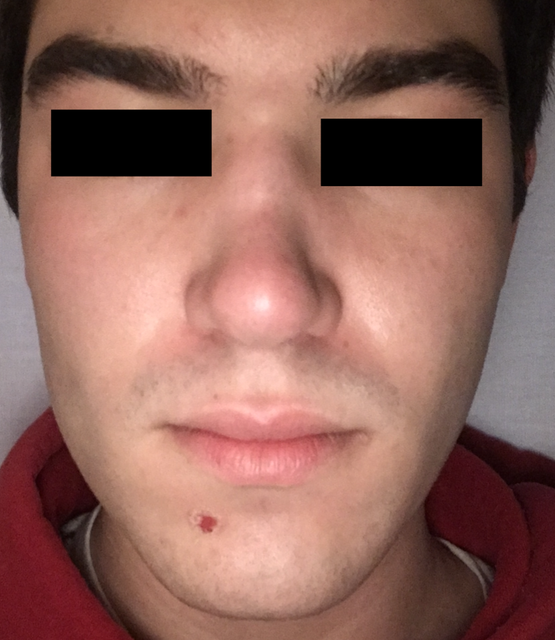 After first rhinoplasty.