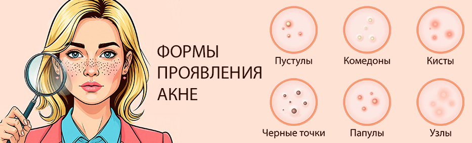 Различные виды акне