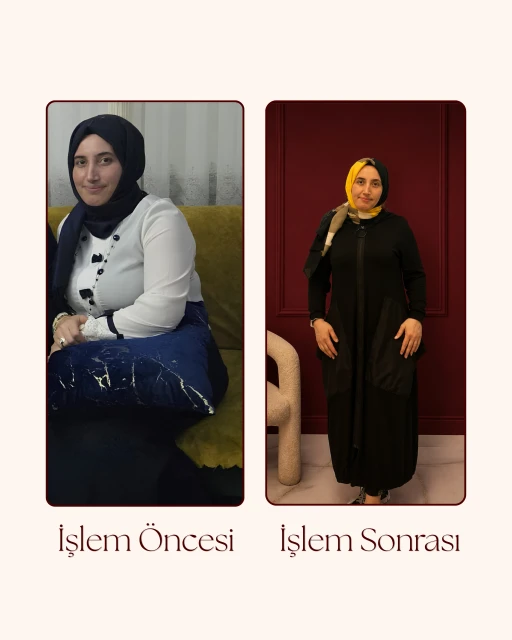 G5 Öncesi Sonrası 7