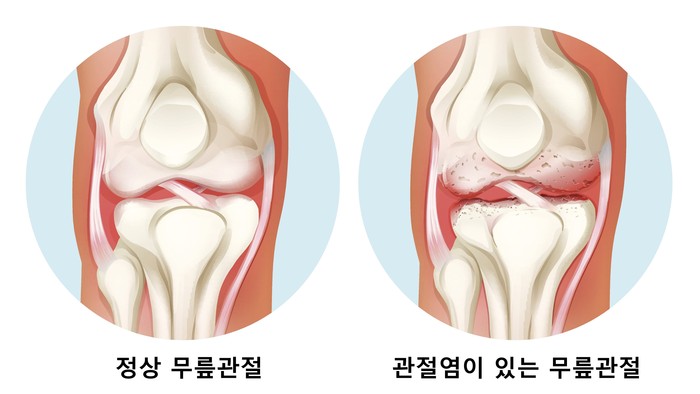 [무릎/관절 아픈 부모님] 의사들도 몰래 실천하는 기적의 아침 루틴 관련 자료 2