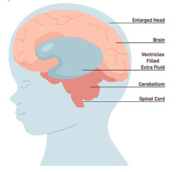 Hydrocephalus