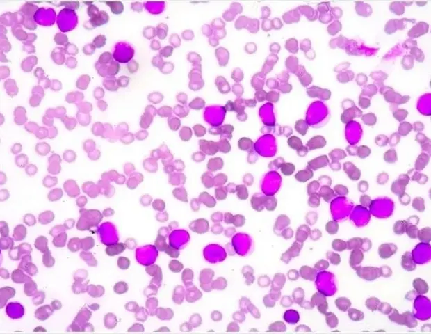 Anemia Medications Show Potential to Inhibit Cancer Cell Development