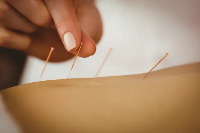 Is the Acupuncture for Pain Relief in NYC the Real Thing?