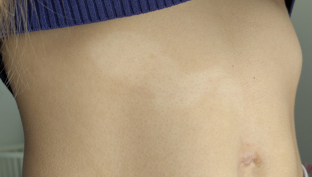 Vitiligo?