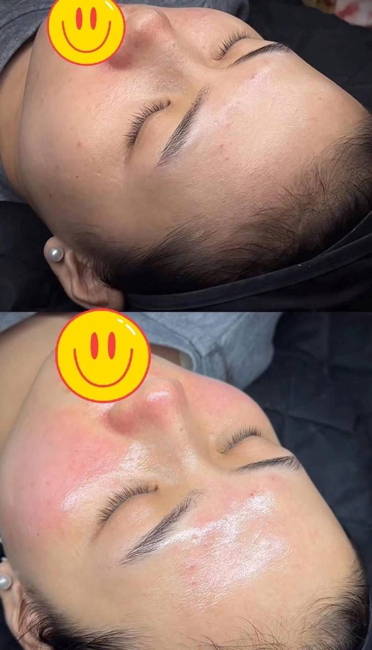 Glow Peel result