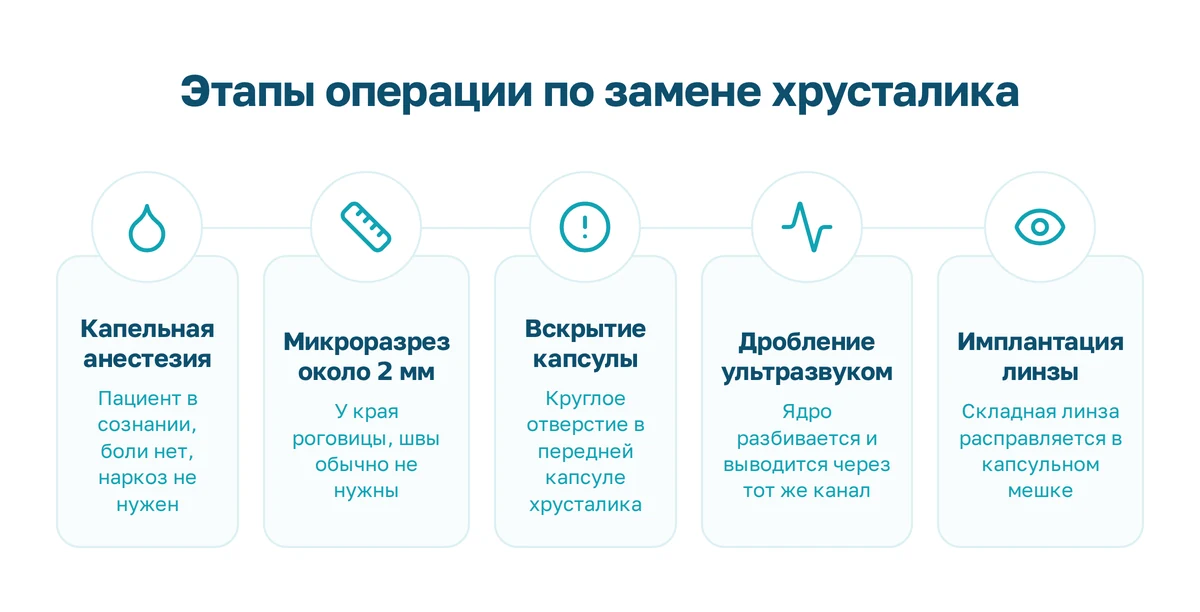 Этапы операции по замене хрусталика