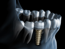 Dental-Implants-Melbourne