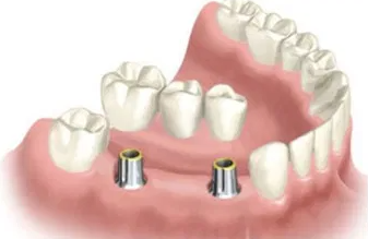 Tooth Implant Melbourne Tooth-Implant-Melbourne
